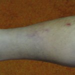 Leg1