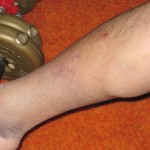 Leg2